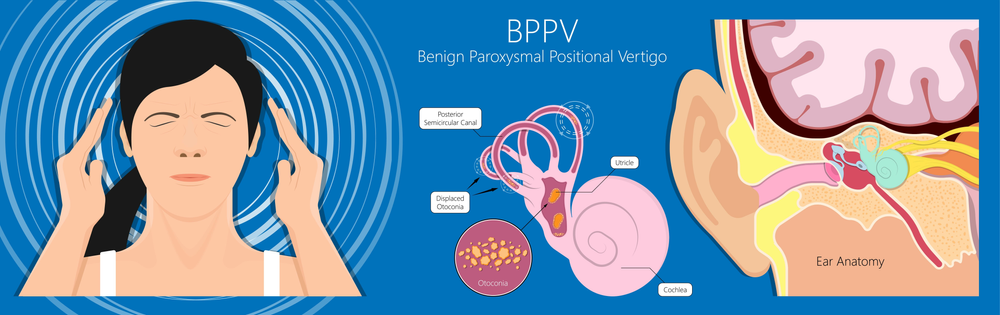 medical abbreviation bppv