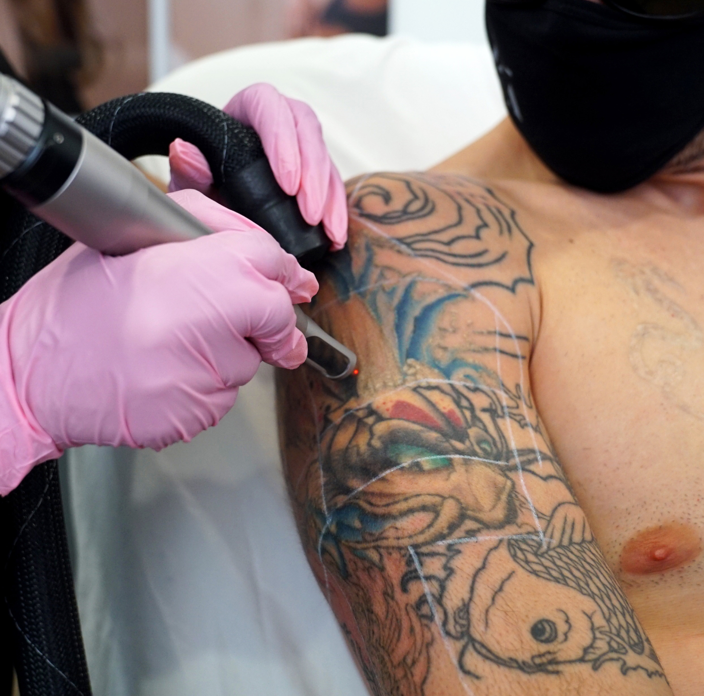 laser tattoo removal santa monica