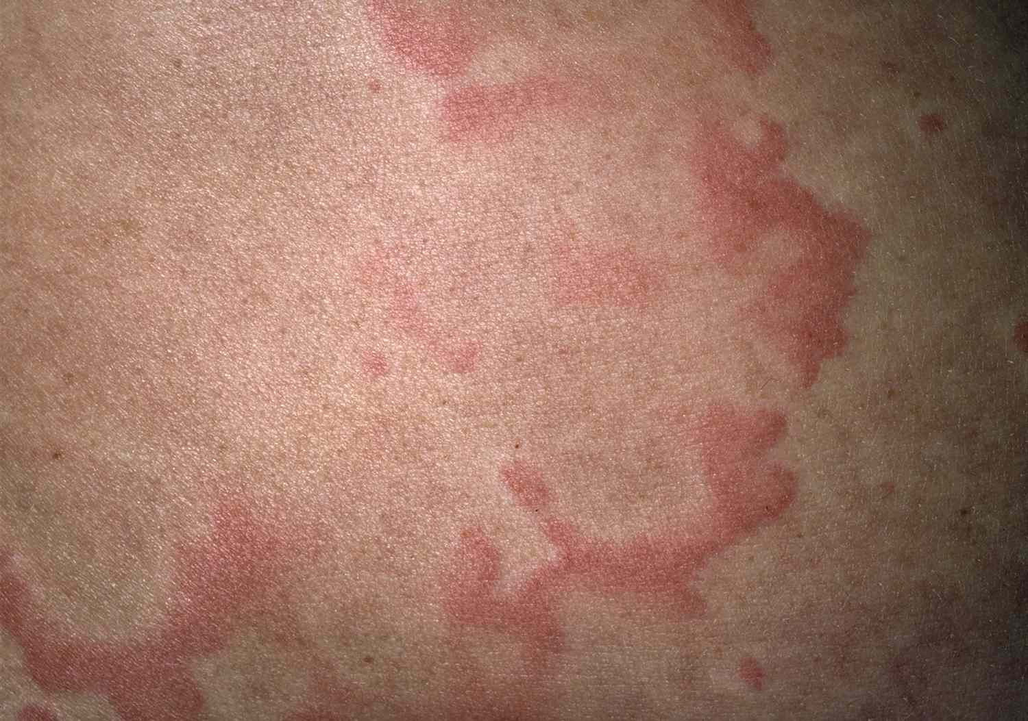 thyroid skin rash pictures face