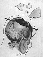 kennedys autopsy