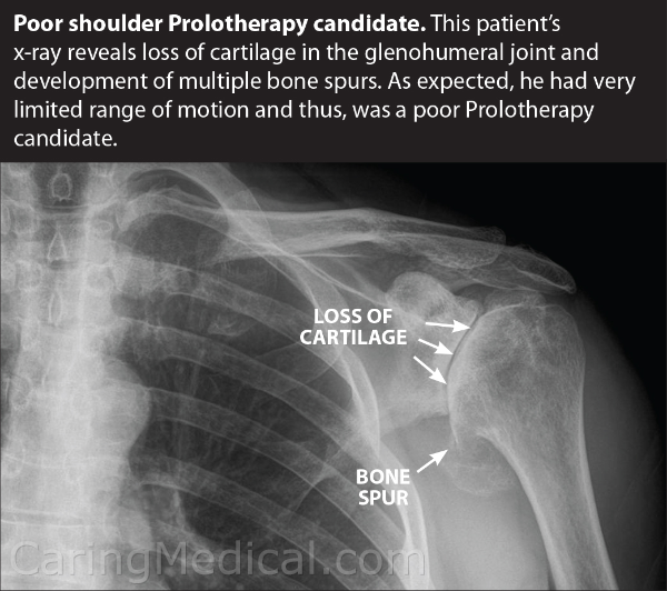 regret shoulder replacement surgery