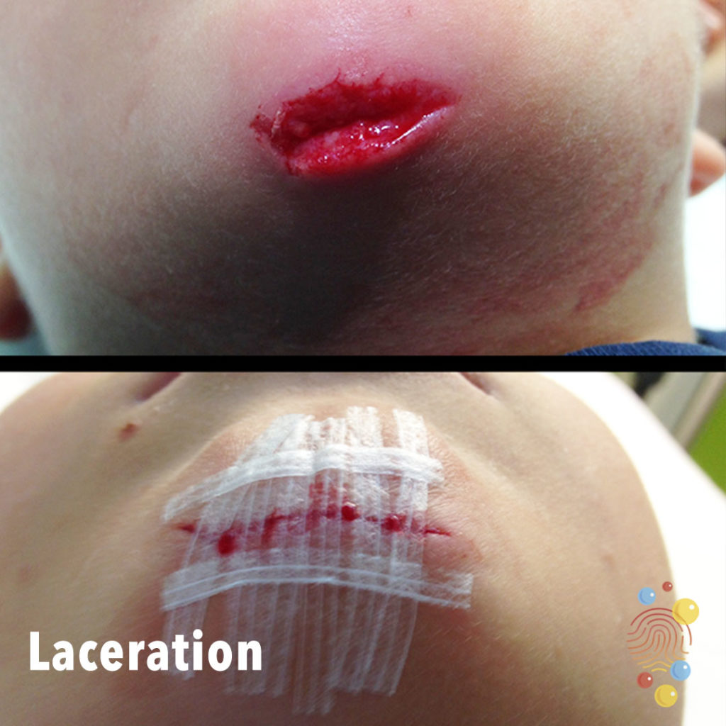 laceration chin icd 10
