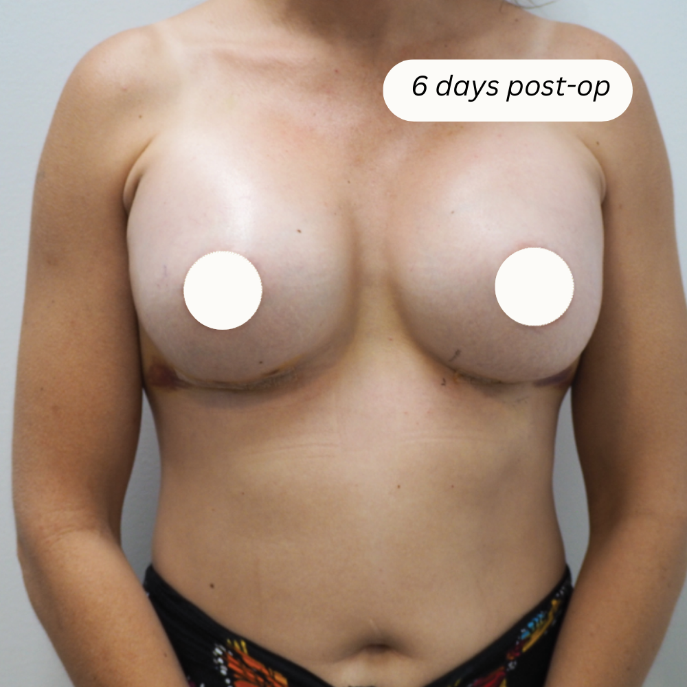breast implants townsville