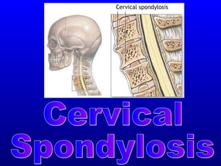 cervical spondylosis ppt