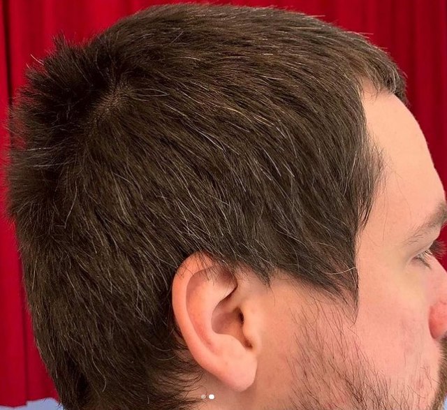 cowlick or balding