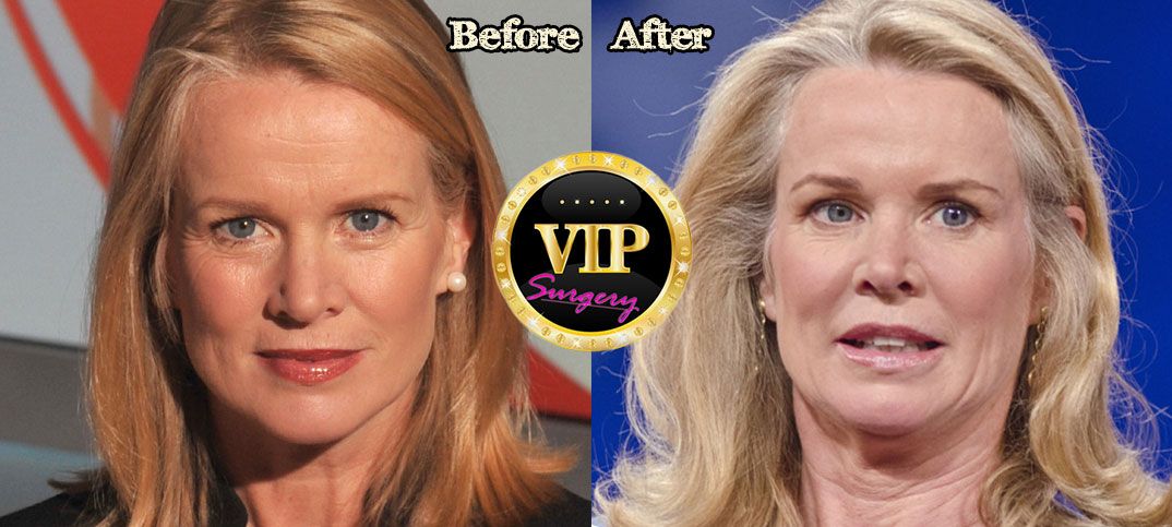 katty kay plastic surgery