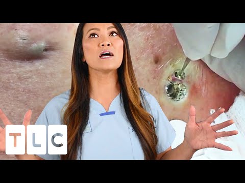 dr pimple popper biggest blackhead