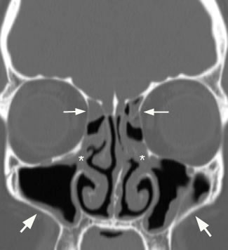 trace mucosal thickening