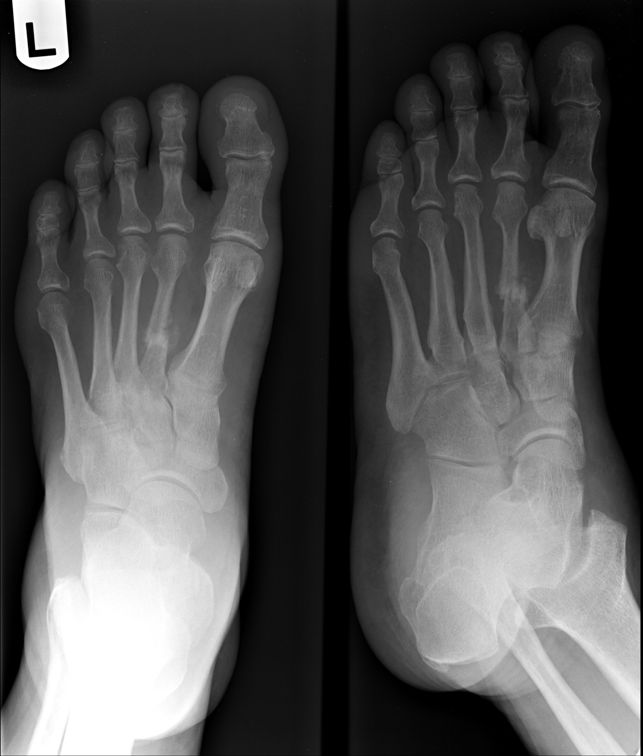 lisfranc fracture radiology