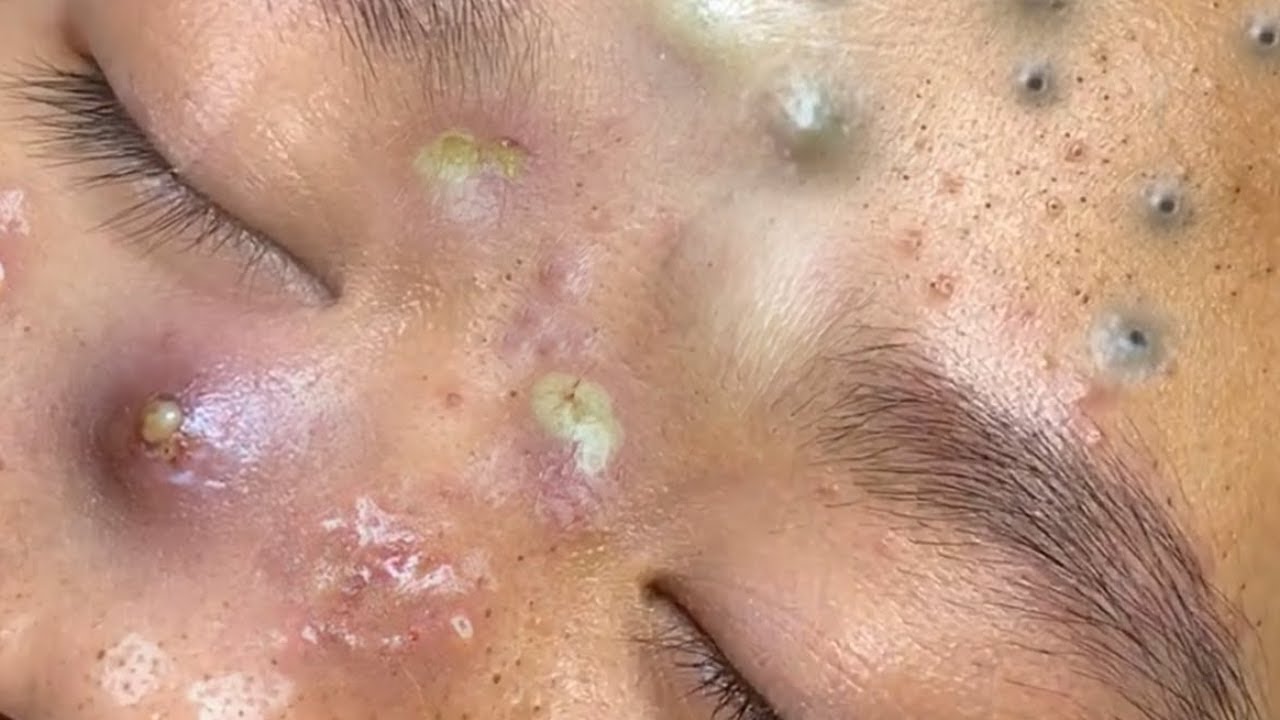 bubuplus blackhead removal 2018