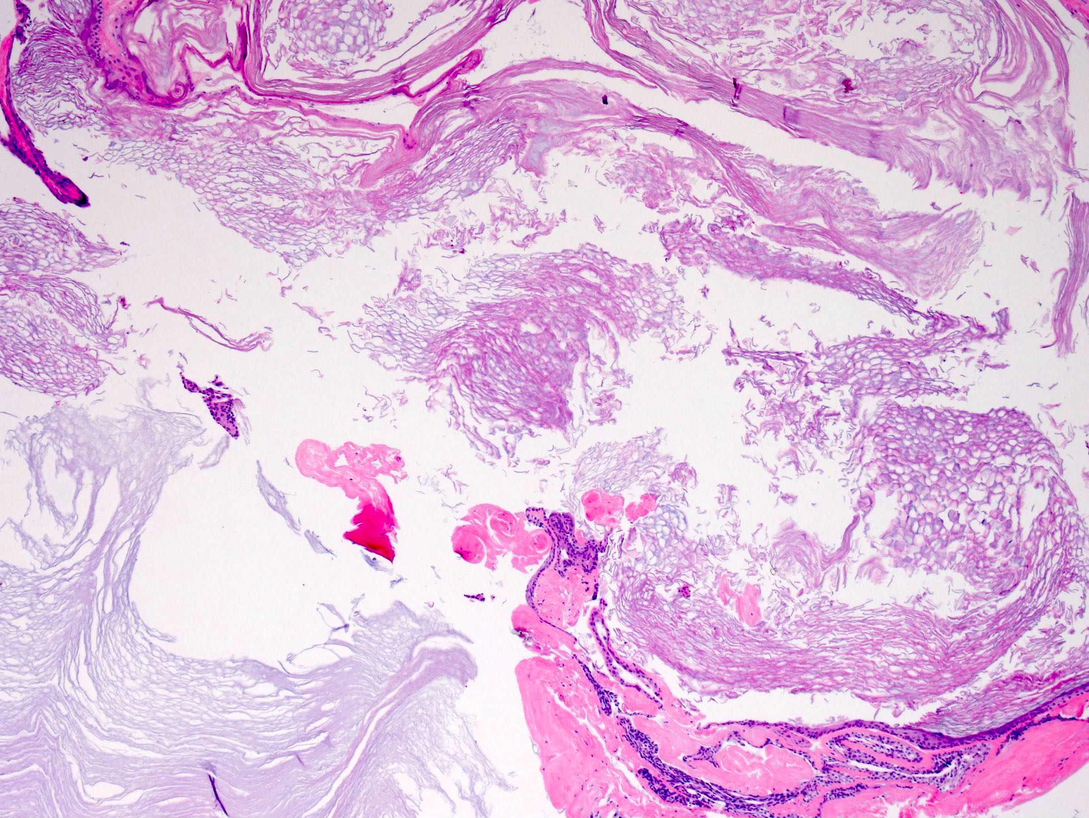 epidermoid cyst pathology outlines