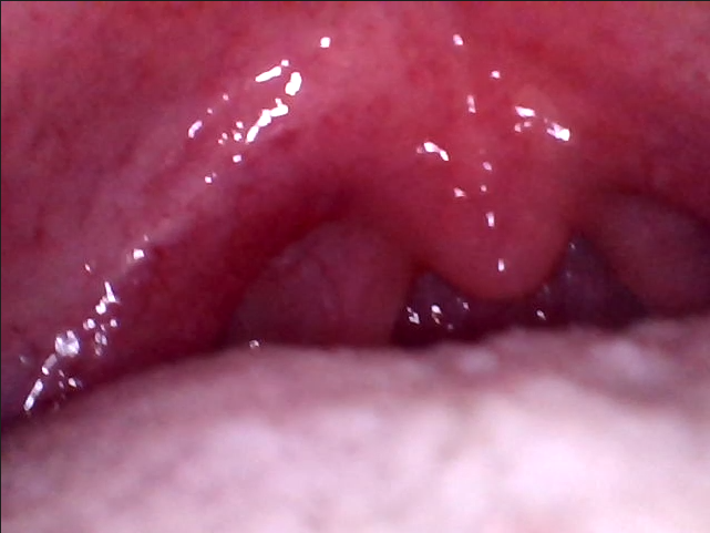 endoscopy vore