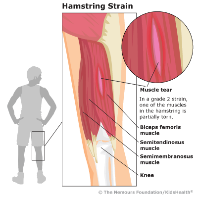 hamstring injury meaning in hindi