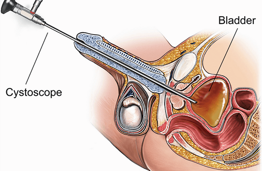 cystoscopy price philippines