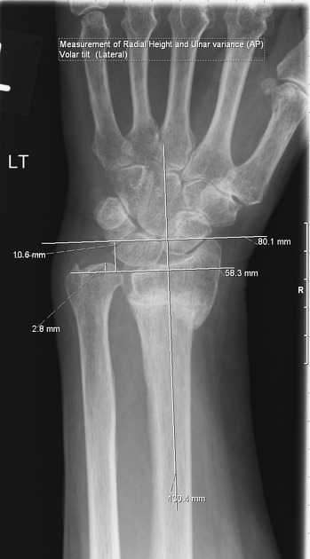 distal radius fracture radiopaedia