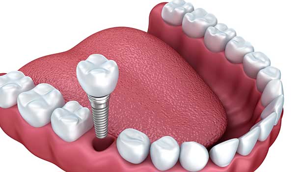 erzurum diş hastanesi implant