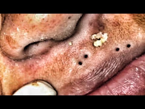 pimple popping videos on youtube