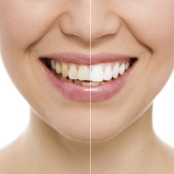 teeth bleaching doncaster east