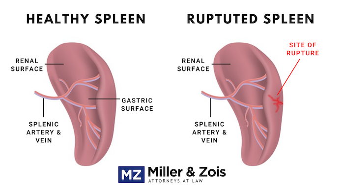 how long can you live with a ruptured spleen
