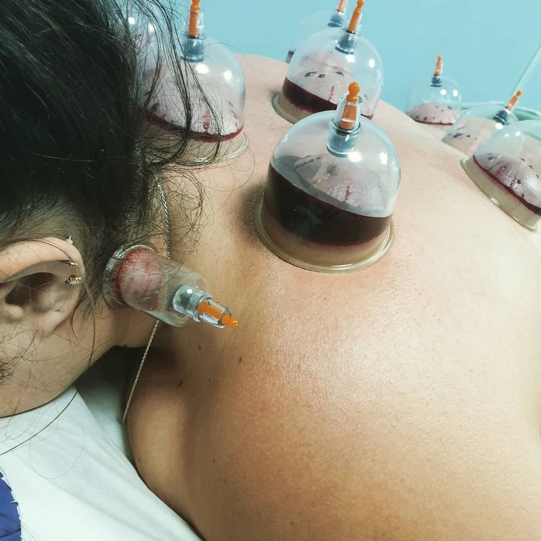 hijama near me