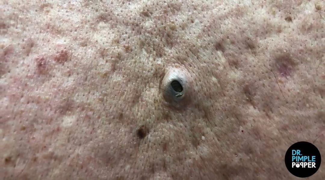 new dr pimple popper blackheads