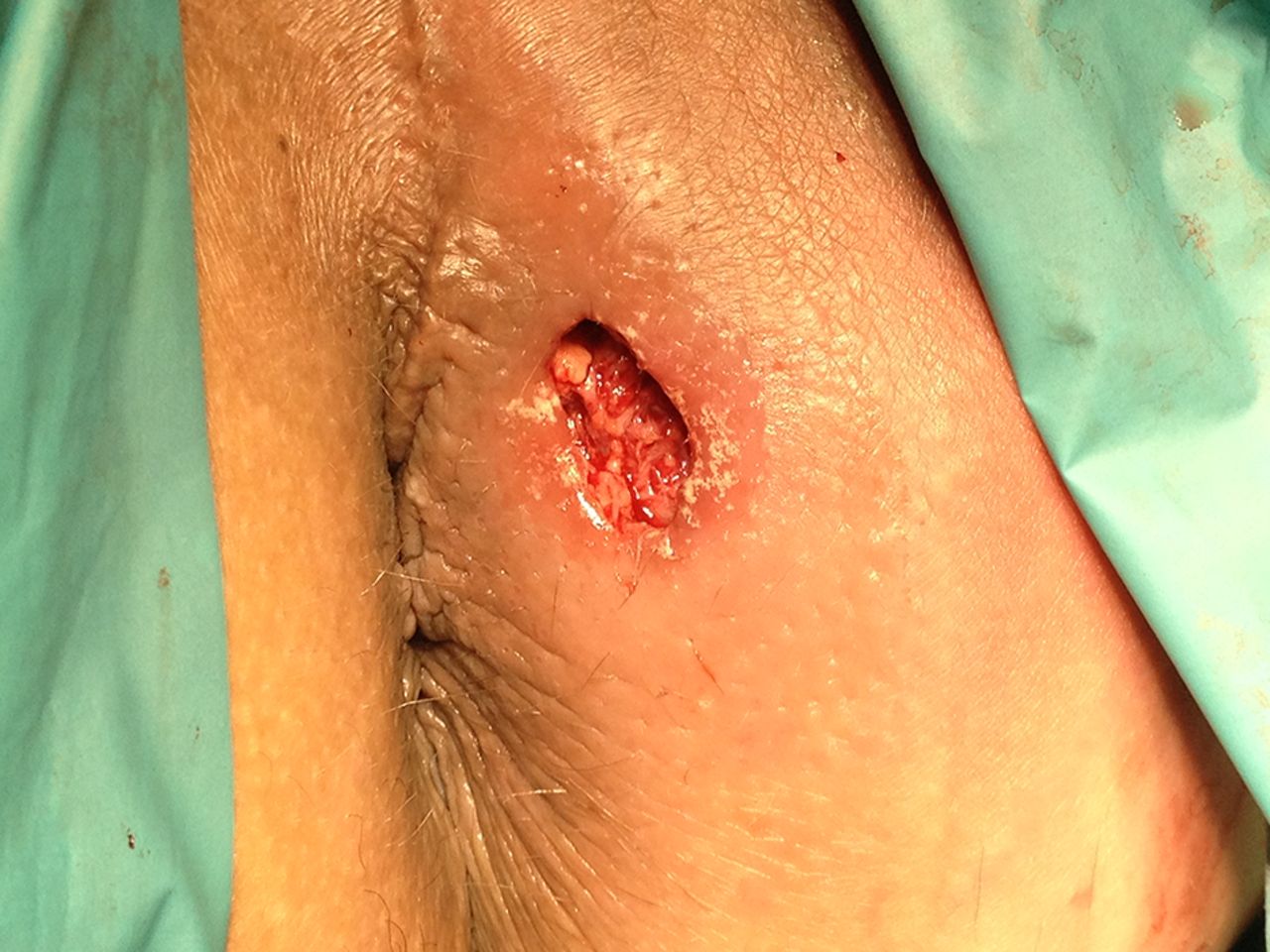 perianal abscess icd