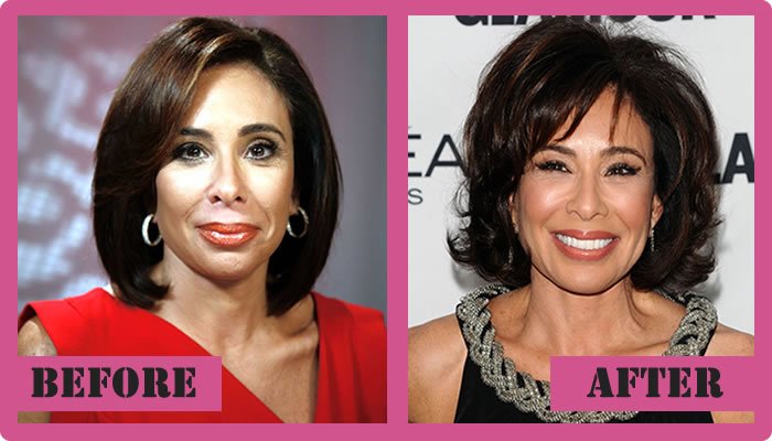 judge jeanine plastic surgery