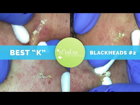 enilsa blackheads