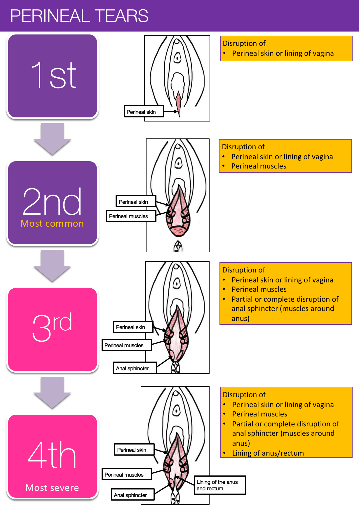 3rd degree perineal tear pictures