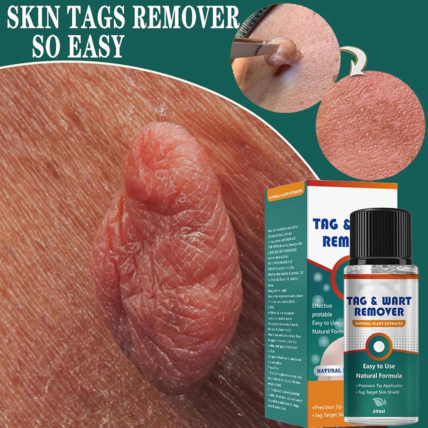 skin tag and wart remover