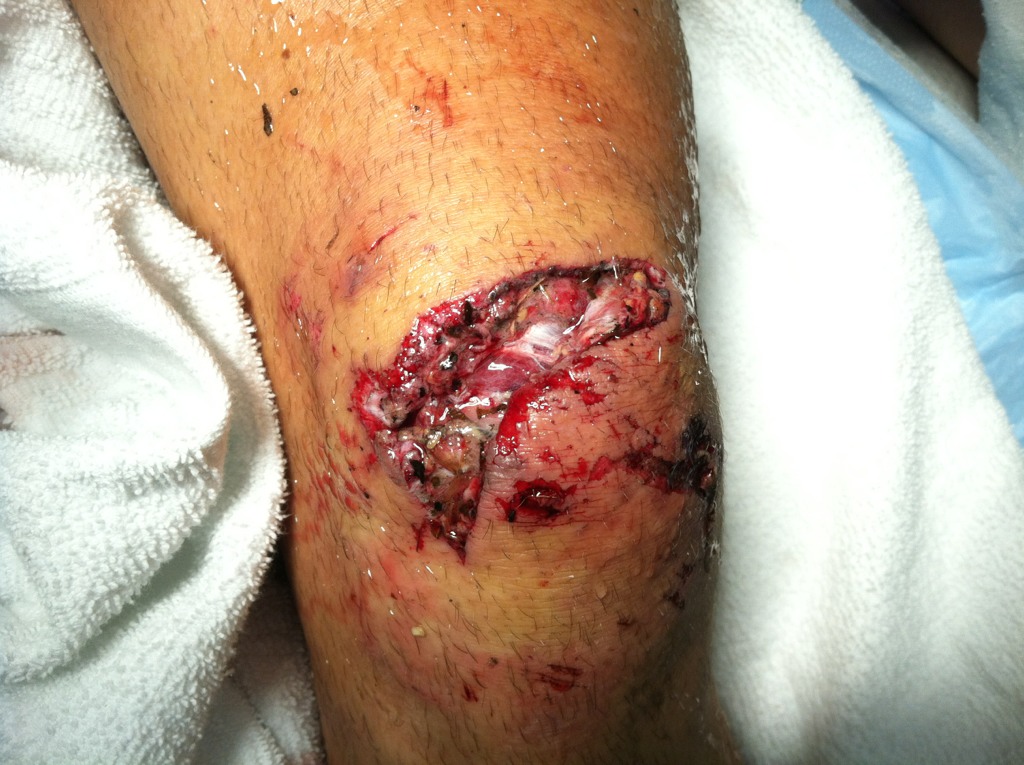 abrasion of right knee icd 10