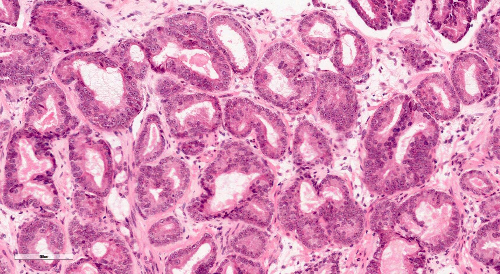 prostate pathology outlines