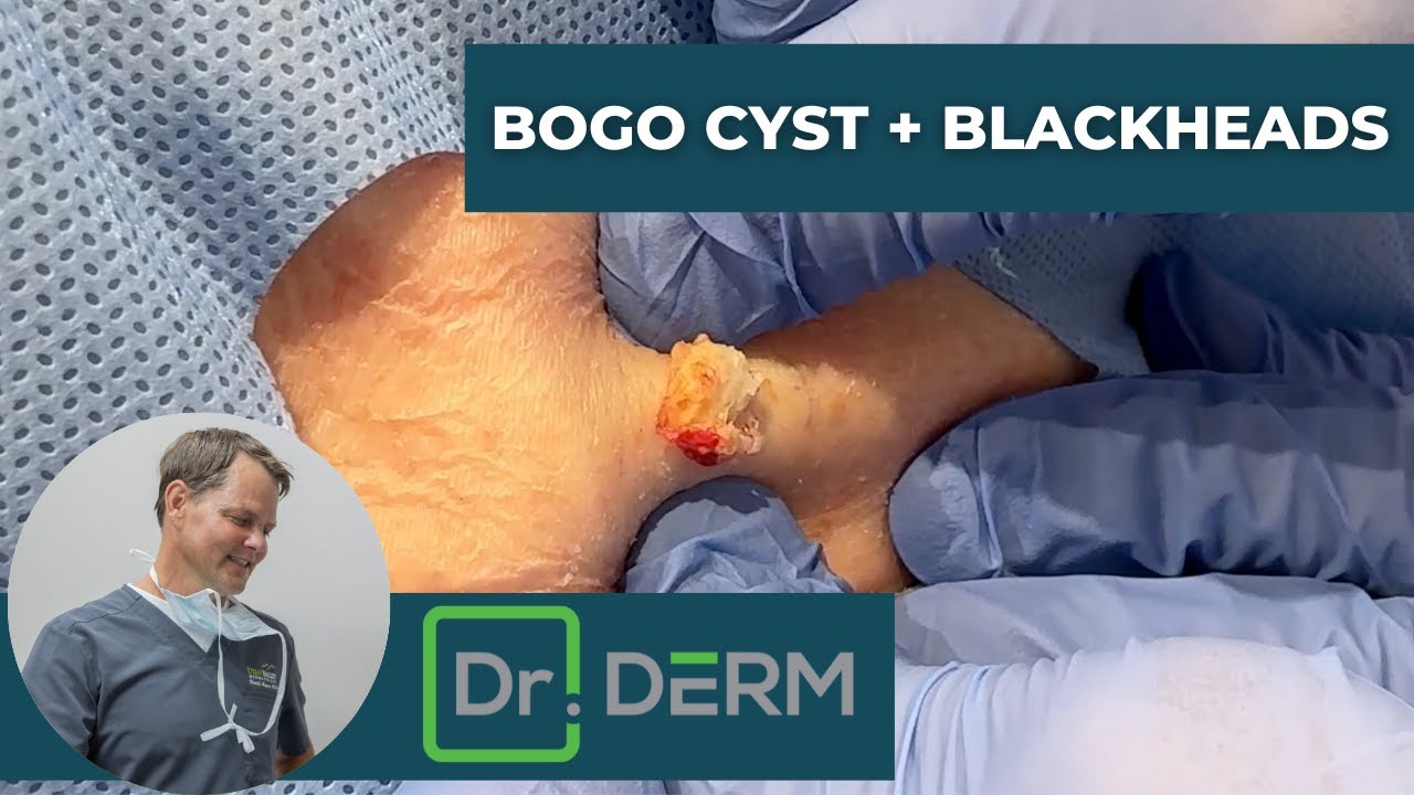 dr derm videos of squeezing blackheads