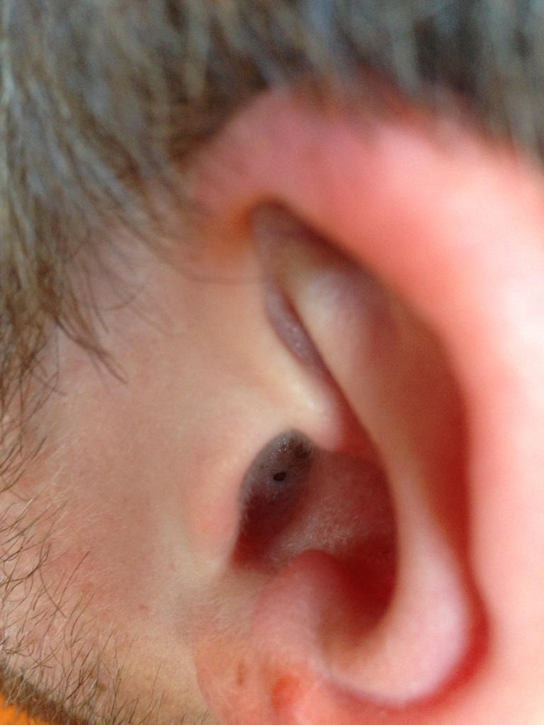 blackheads inside ear