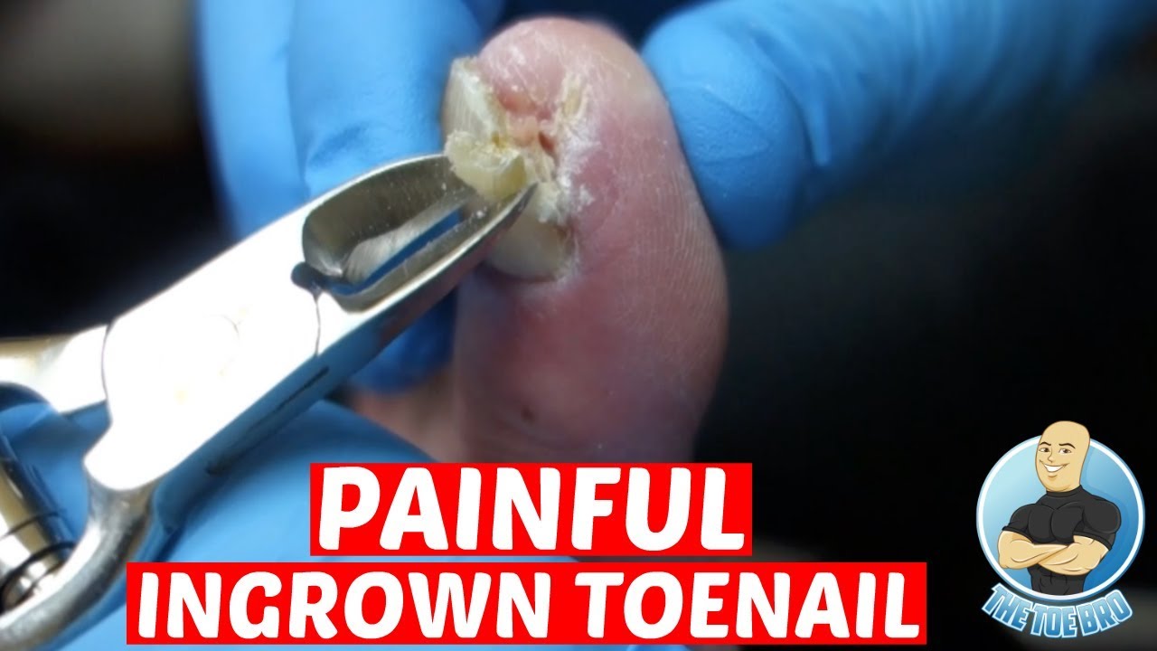 how to remove ingrown toenail youtube