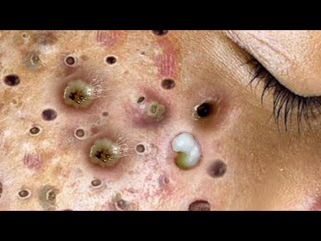 blackheads removal youtube