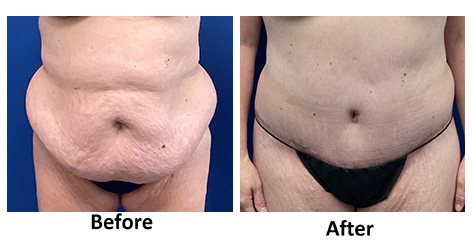 tummy tuck louisville ky