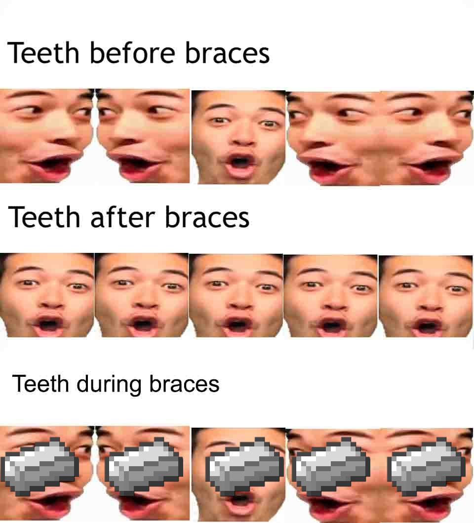 funny braces memes