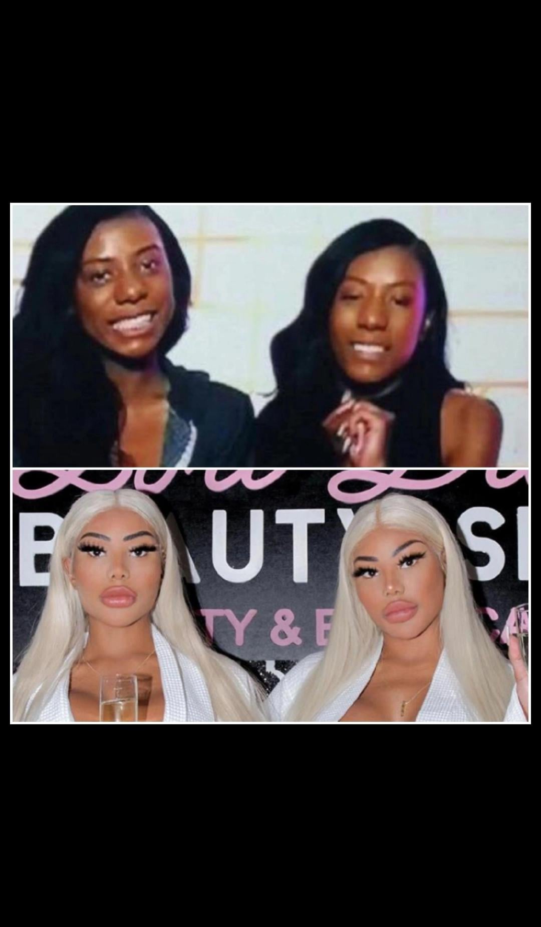 clermont twins before and after surgery