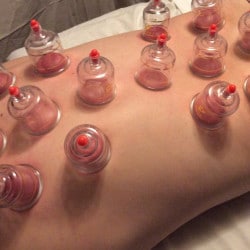 cupping therapy in ahmedabad