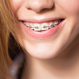 dental braces for kids maple ridge