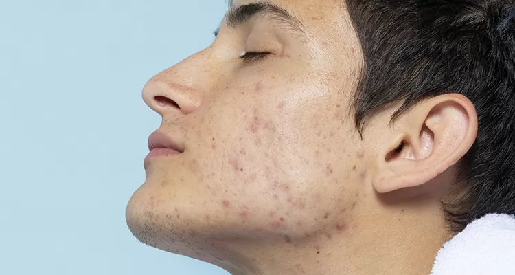 does masturbating give you acne
