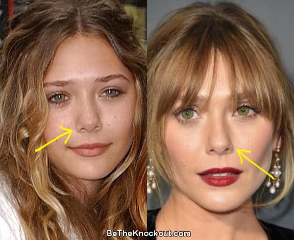 elizabeth olsen plastic surgery