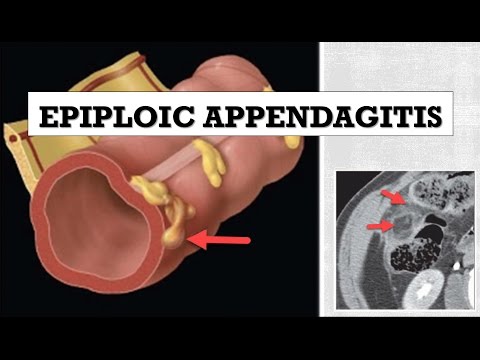 epiploic appendagitis icd 10