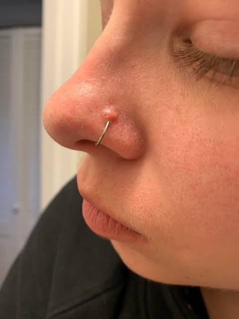 nose piercing keloid