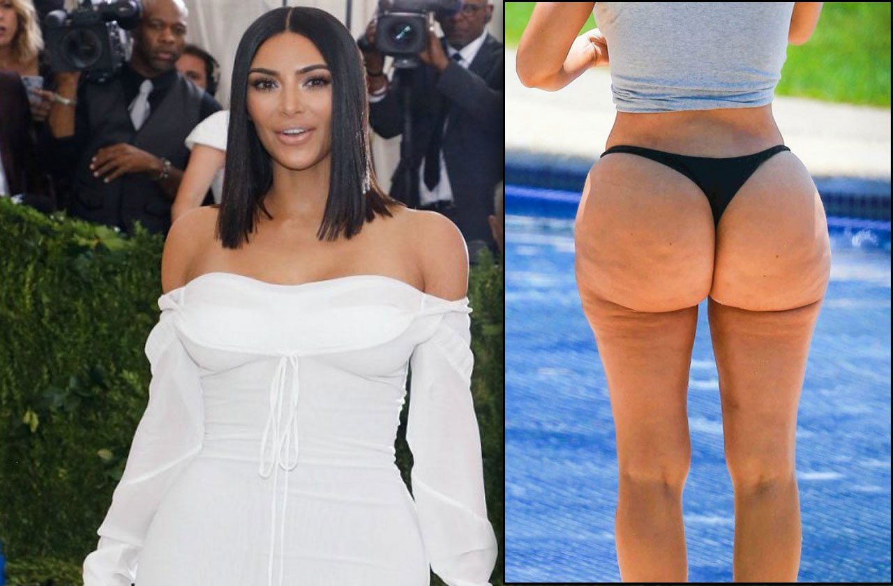 lipedema kim kardashian