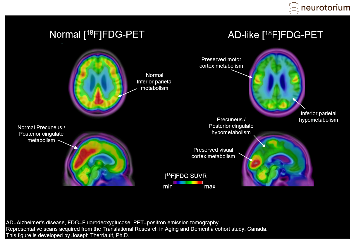 fluorodeoxyglucose positron emission tomography