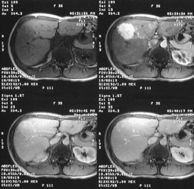 focal nodular hyperplasia liver