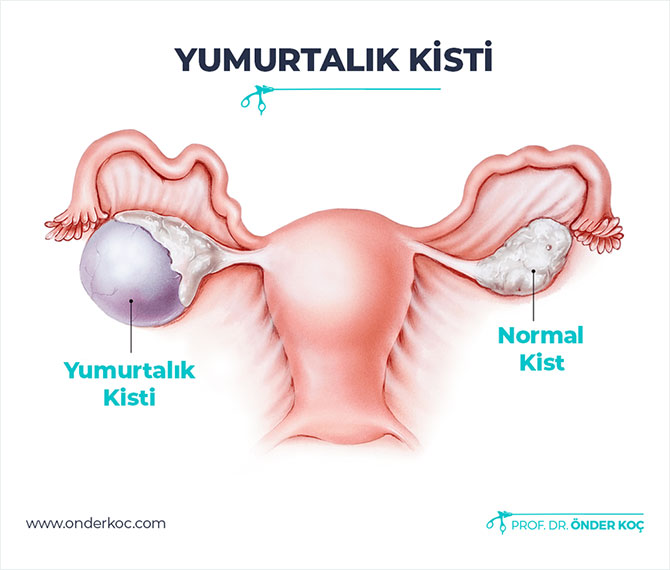 hamilemiyim kist mi var