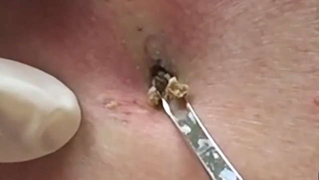 massive blackhead on back